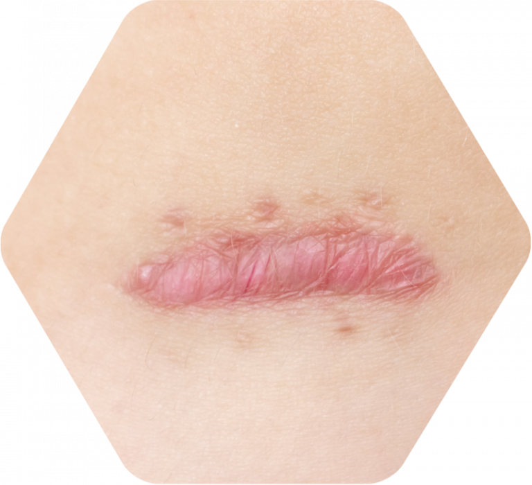 Narbenbehandlung bei Ihrem Hautarzt in Dithmarschen I Dermatologie Meldorf